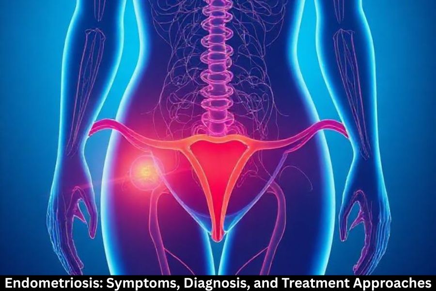 Endometriosis: Symptoms, Diagnosis, and Treatment Approaches