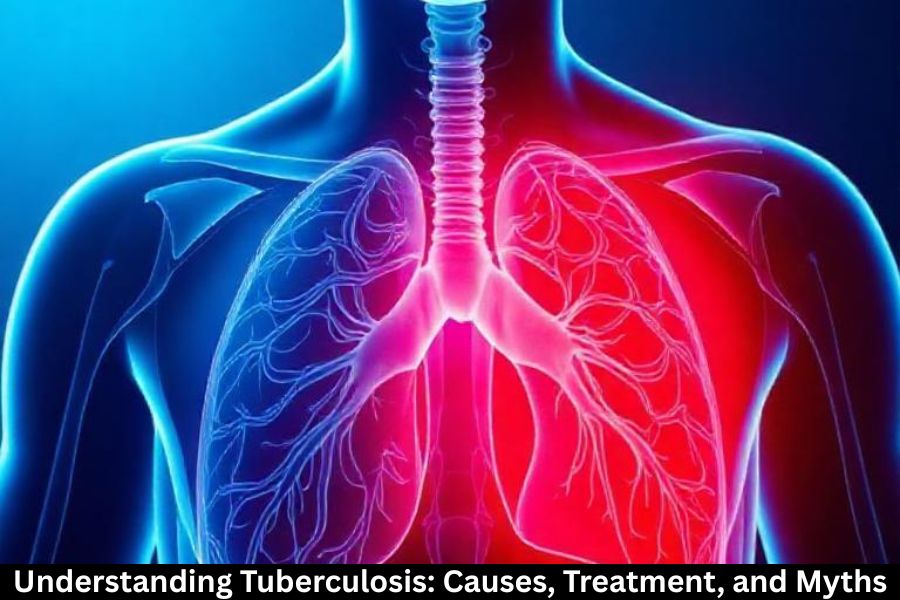 Understanding Tuberculosis: Causes, Treatment, and Myths.